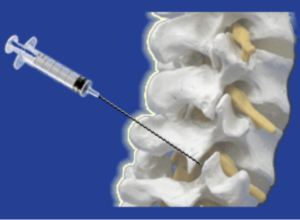 幹細胞培養上清液による変性椎間関節修復法